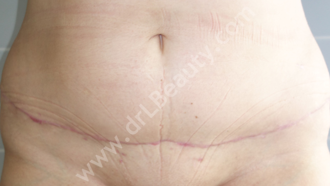 drlbeauty_elotte_utana_hasplasztika4