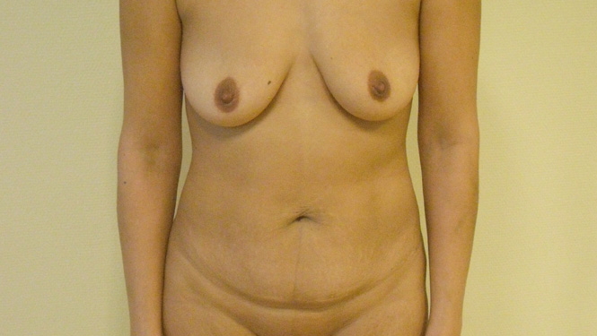 drlbeauty_elotte_utana_mellplasztika_es_hasplasztika3