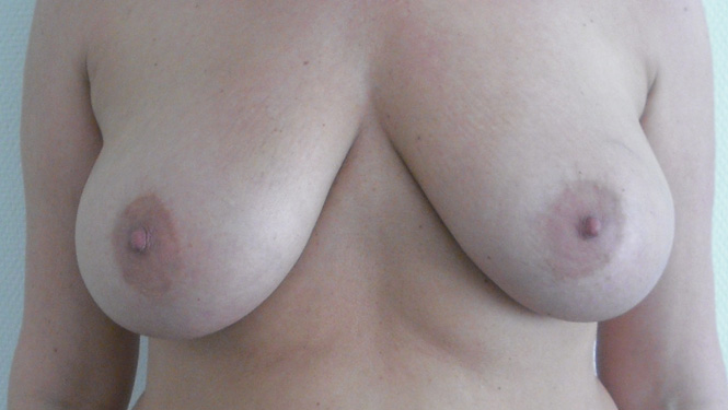 drlbeauty_elotte_utana_mellplasztika_es_hasplasztika5