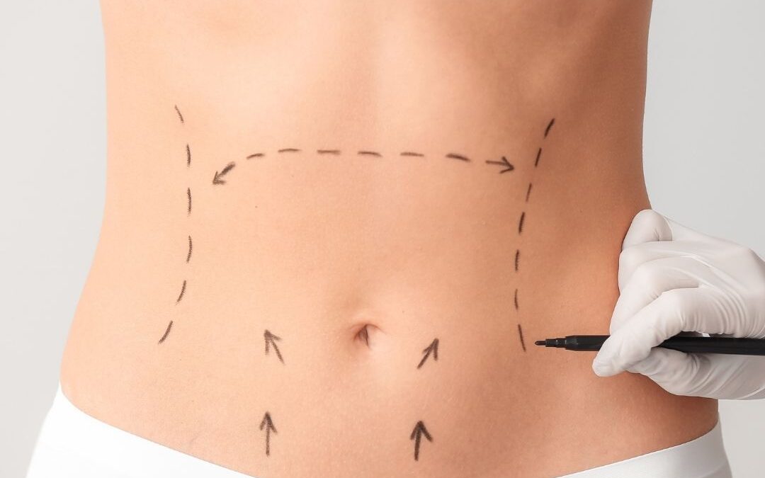 Hasplasztika szülés után?